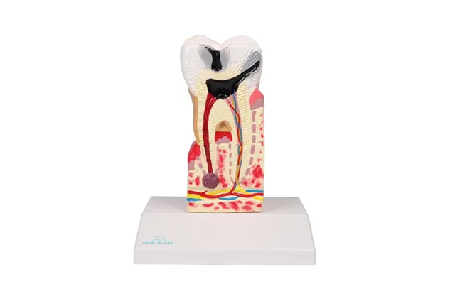 Caries Model - 10 Gange Naturlig Størrelse