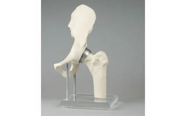 Hip Hop Med Implantater - Birmingham Hip