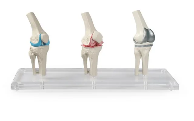 Knæimplantat Model