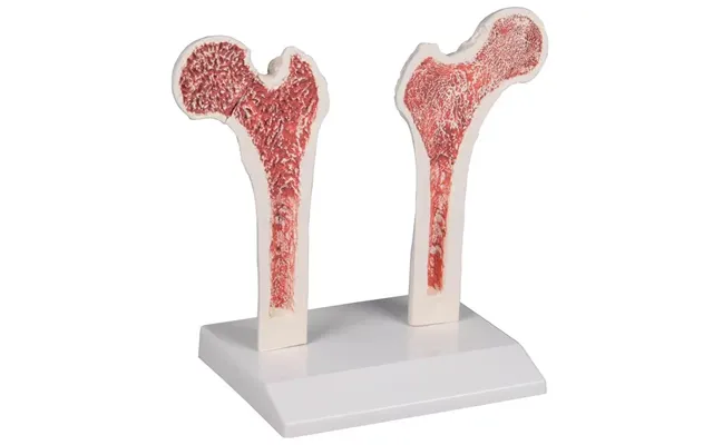 Osteoporose Femur