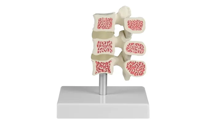 Osteoporose Hvirvelmodel - 3 Hvirvler