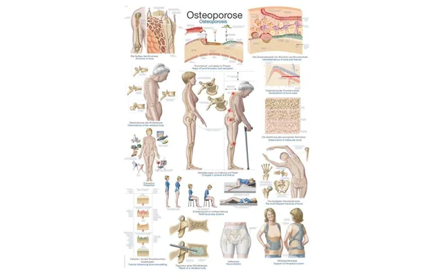 Plakat Osteoporose - 70x100cm