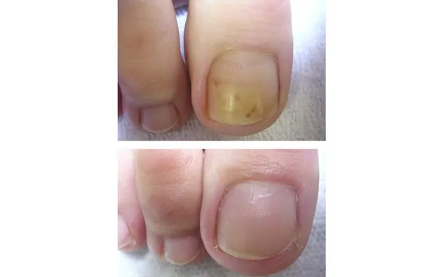 Footlogix Anti-fungal Toe Tincture Spray 50ml product image