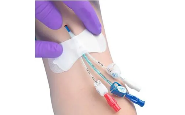 Zefon Tidi Grip-loksecurement Device - For Universal Picc Catheter