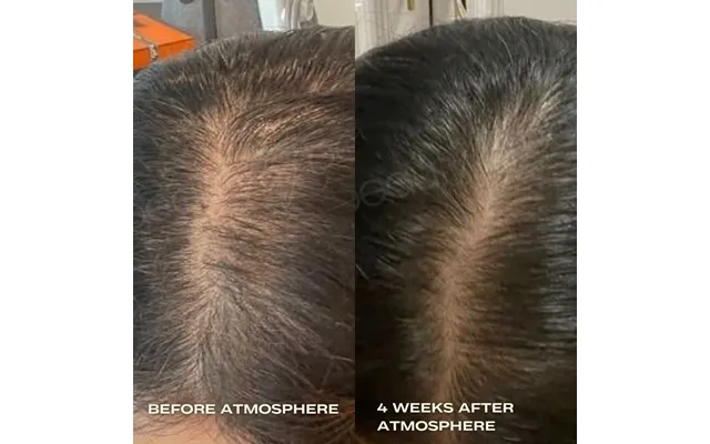 Aphrodite Hair Density Kit