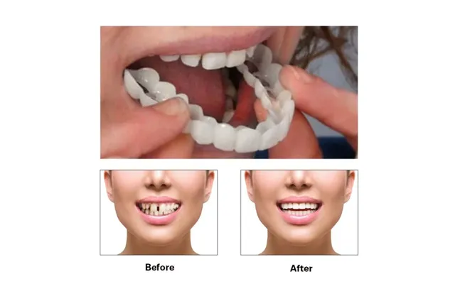 Adjustable Set Instant Smiling Veneer Whitening Tooth Denture Braces Decorate The Gaps Between Teeth