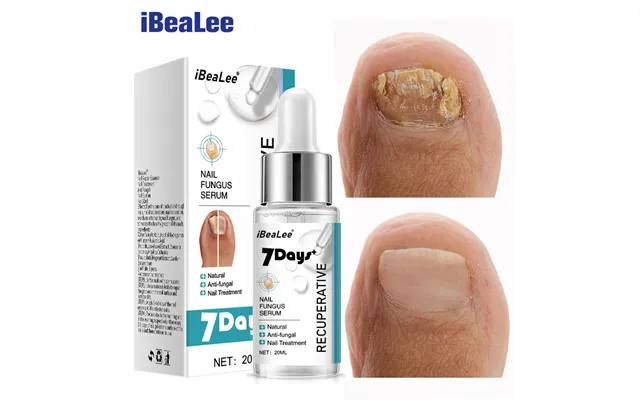 Special Antibacterial Nail Removal Cream Thickening Soft Nails - And Special Solution For Gray Nails